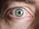 inflammation des yeux