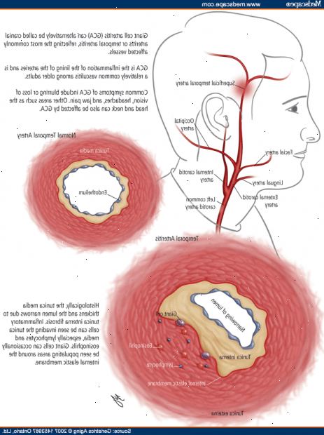 Artérite à cellules géantes Syqana